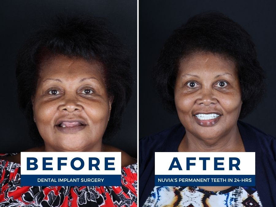 Woman smiling before and after having snap in dentures replaced by dental implants
