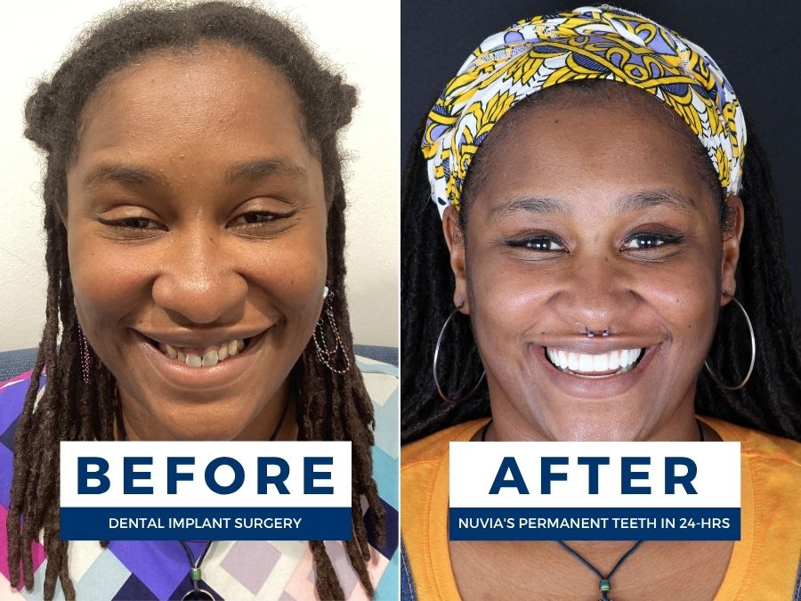 Woman smiling before and after having snap in dentures replaced by dental implants