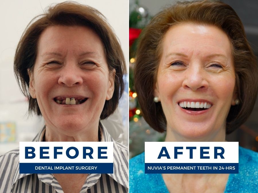 Woman smiling before and after having snap in dentures replaced by dental implants