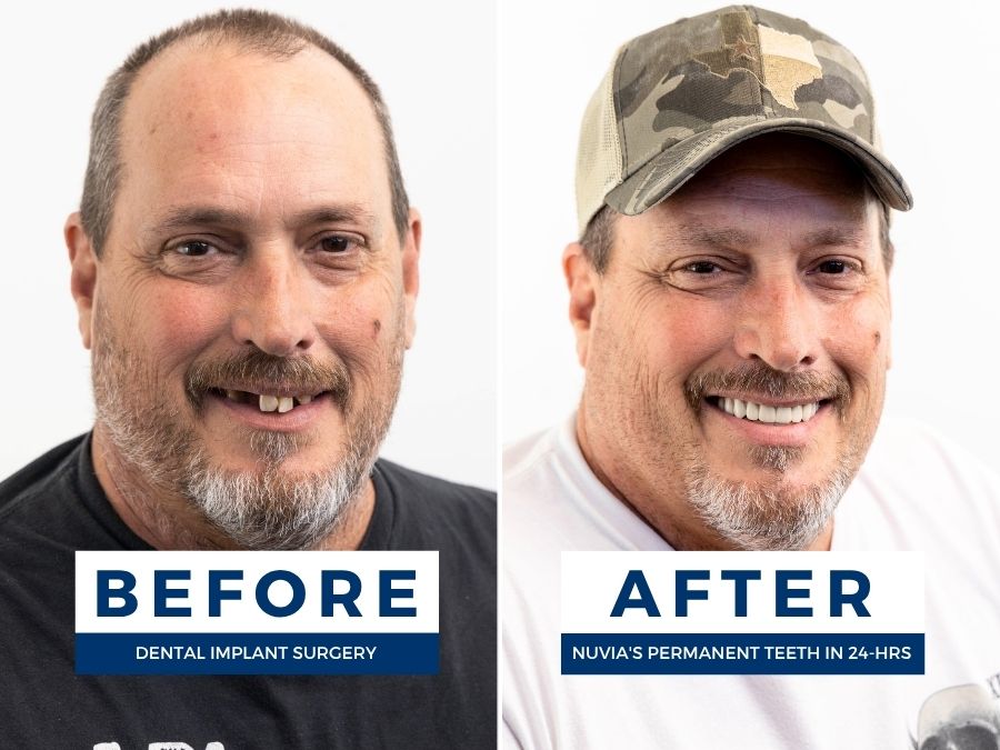 Man smiling before and after getting affordable dental implants