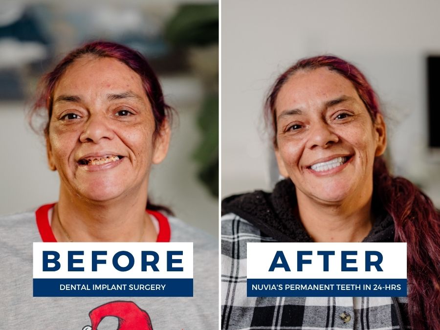 Woman smiling before and after having snap in dentures replaced by dental implants