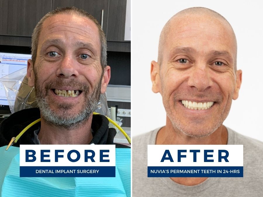 Man smiling before and after getting affordable dental implants