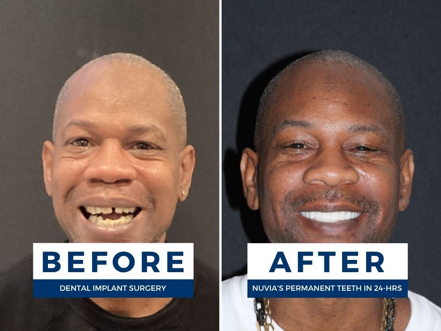 Man smiling before and after having snap in dentures replaced by dental implants