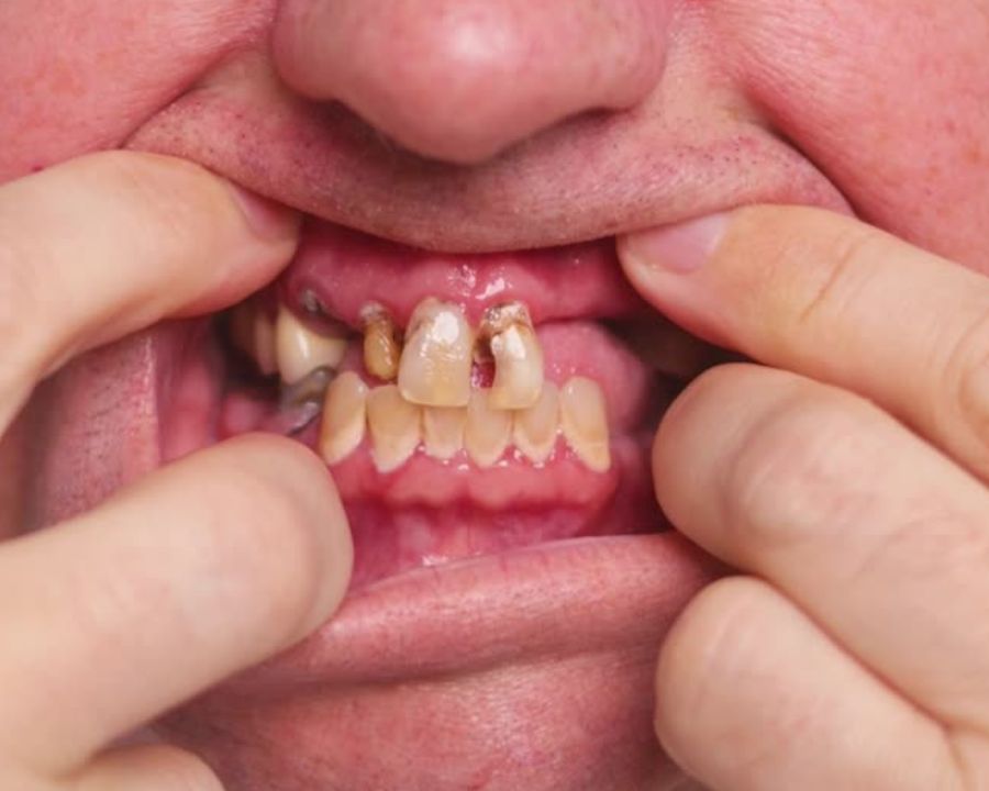 Man pulling lips back to show gum disease and failing teeth