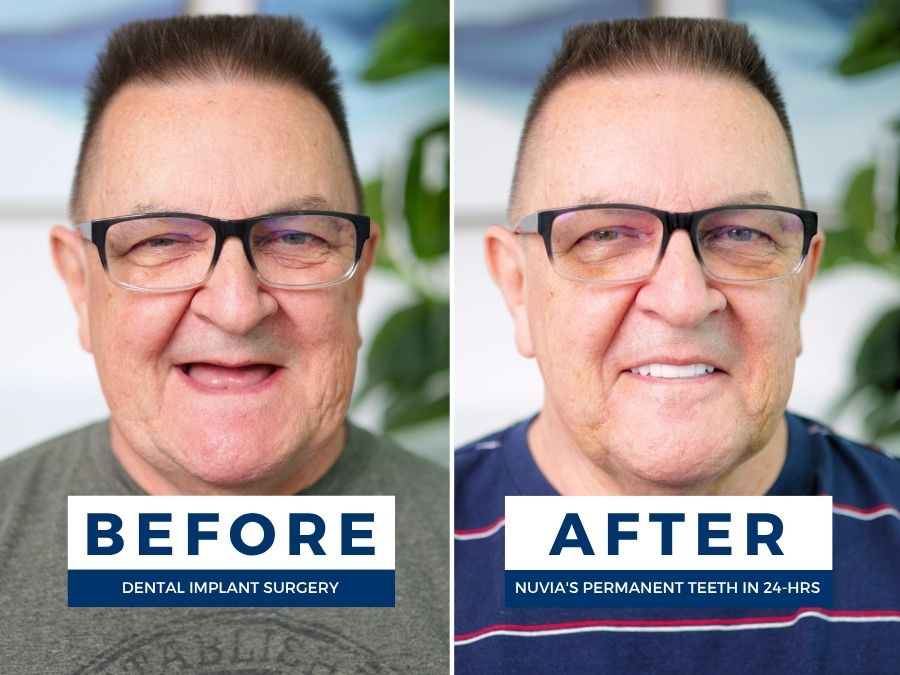 Man smiling before and after replacing dentures with dental implants