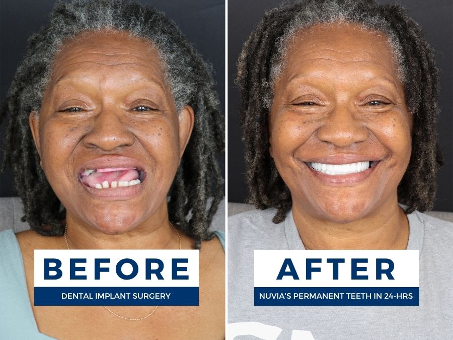 Woman smiling before and after getting a new smile with affordable dental implants