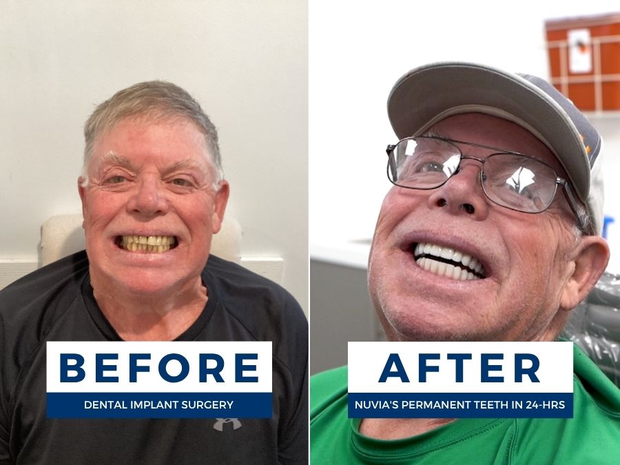 Man smiling before and after having snap in dentures replaced by dental implants