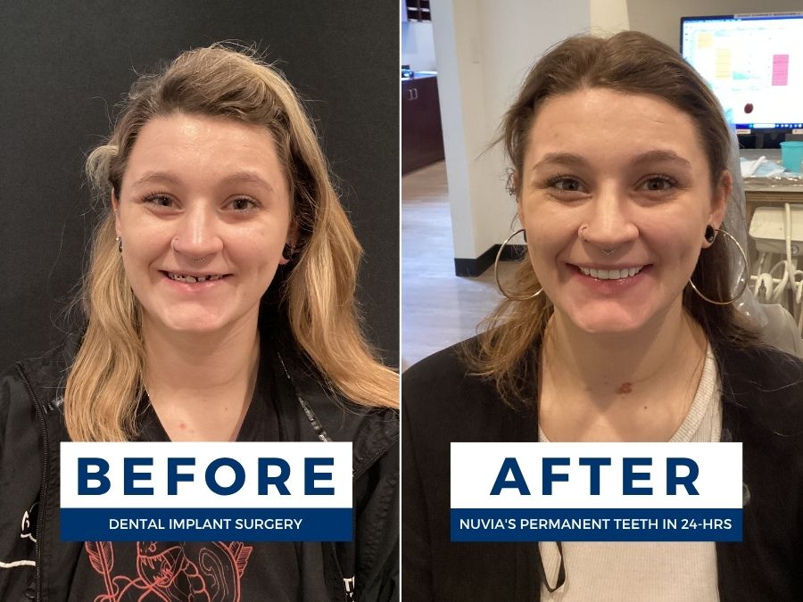 Woman smiling before and after having snap in dentures replaced by dental implants