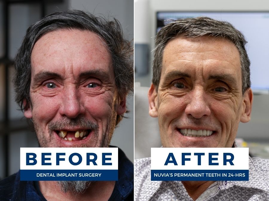 Man smiling before and after having snap in dentures replaced by dental implants