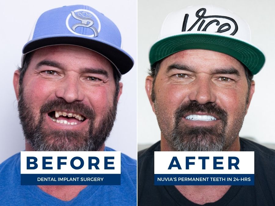 Man smiling before and after restoring his teeth from dental trauma in the past