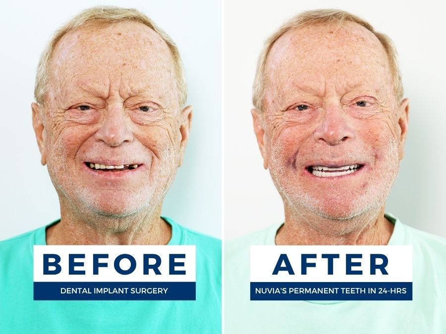 Man smiling before and after having snap in dentures replaced by dental implants