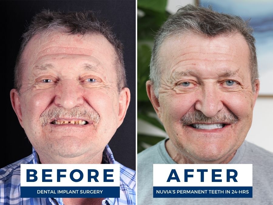 Man smiling before and after having snap in dentures replaced by dental implants