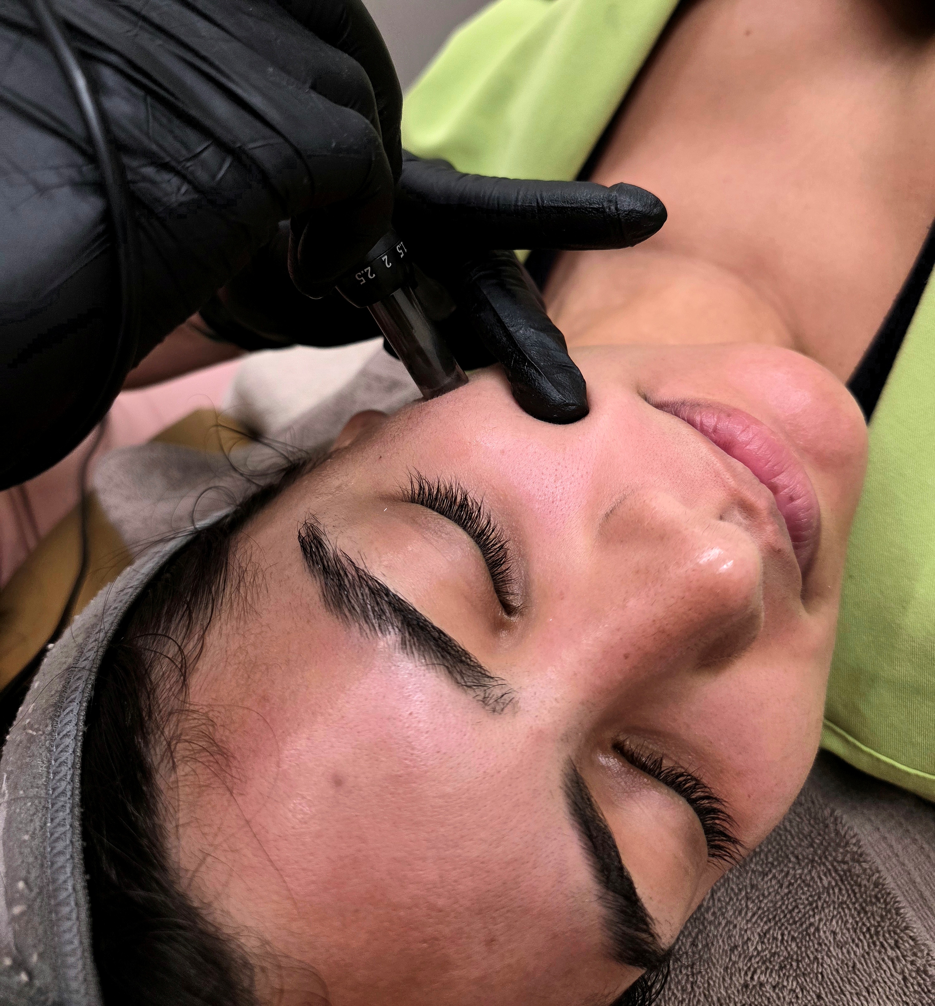 Toskani skin boosters with Lumicen salmon DNA for skin regeneration hydration and texture improvement