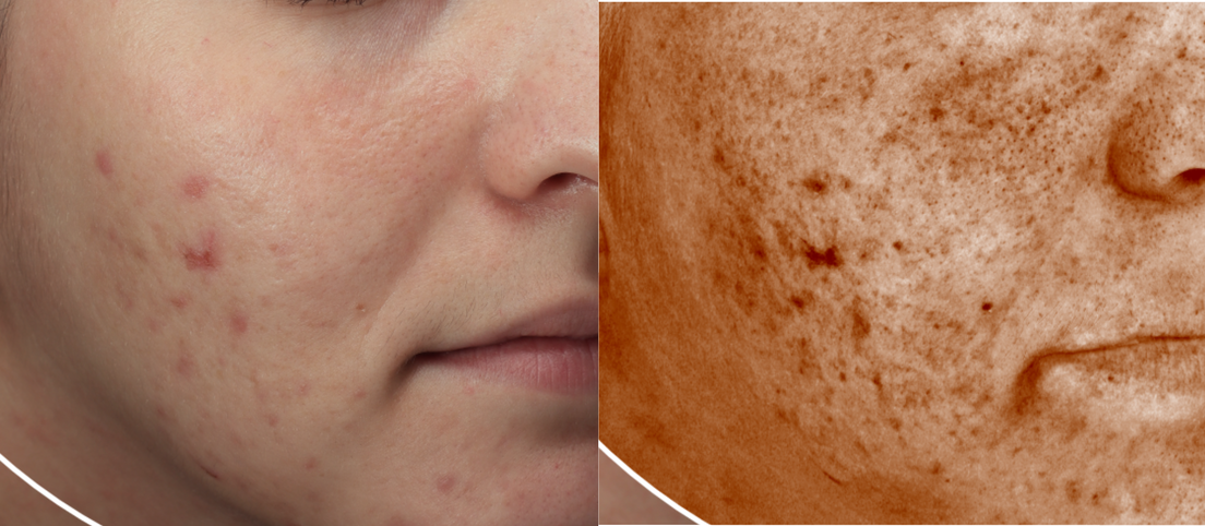 Post inflammatory hyperpigmentation treatment before and after