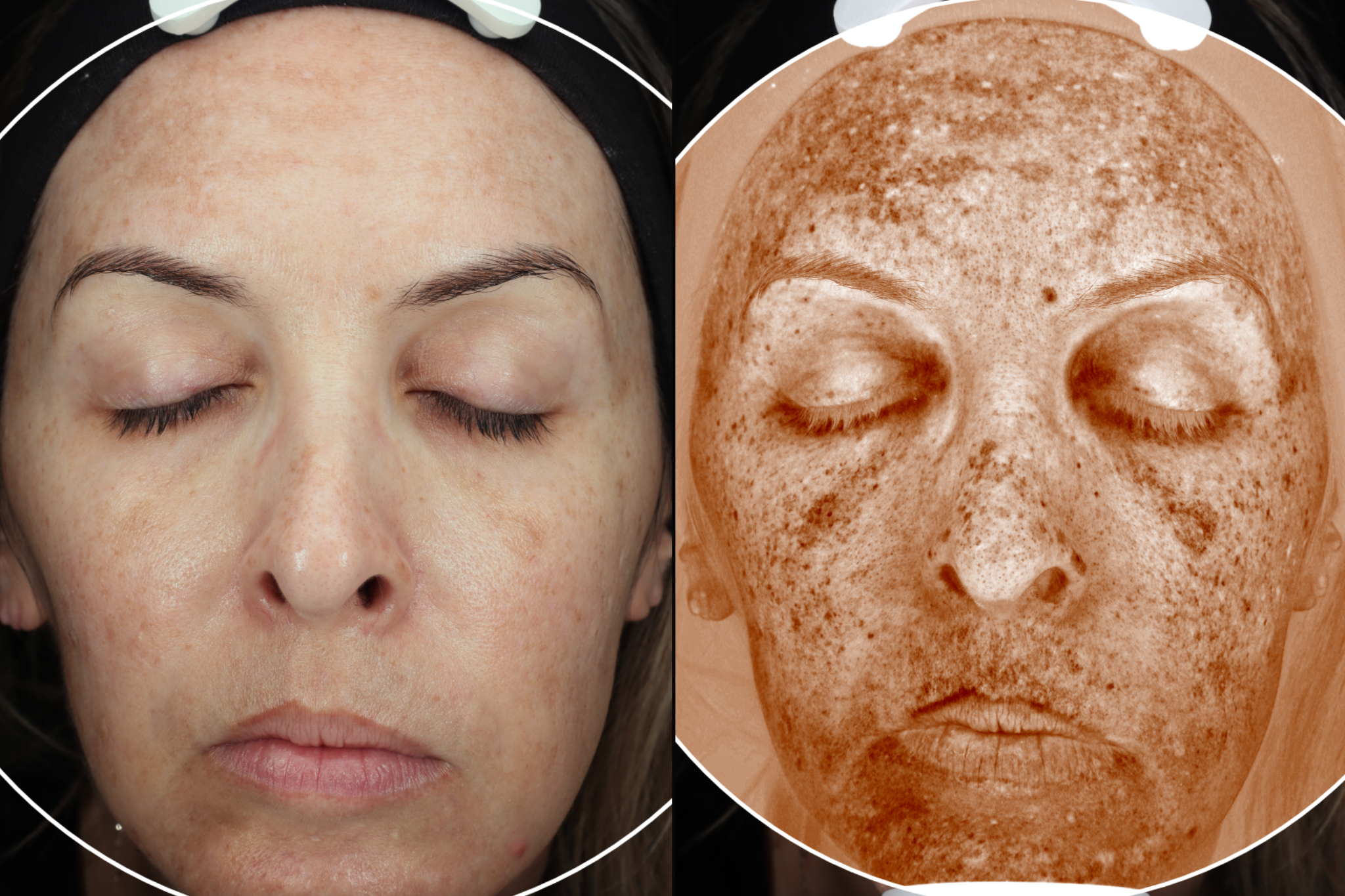 Melasma imaging before treatment with SylfirmX
