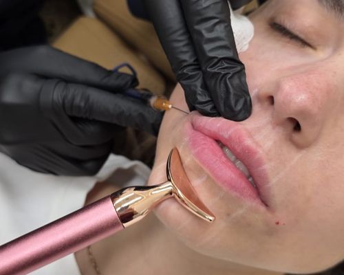 Lip Renaissance Filler at DoctoraVital Med Spa Cooper City Fl