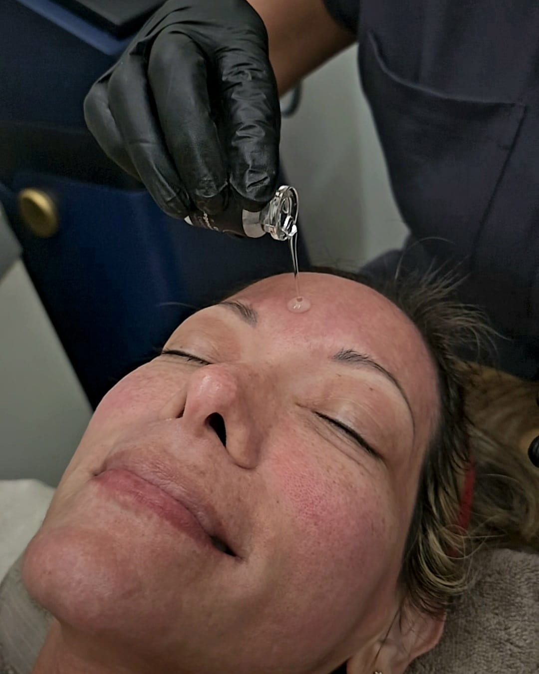 Benev Exosomes after a SylfirmX treatment for skin tightening at Doctoravital Med Spa