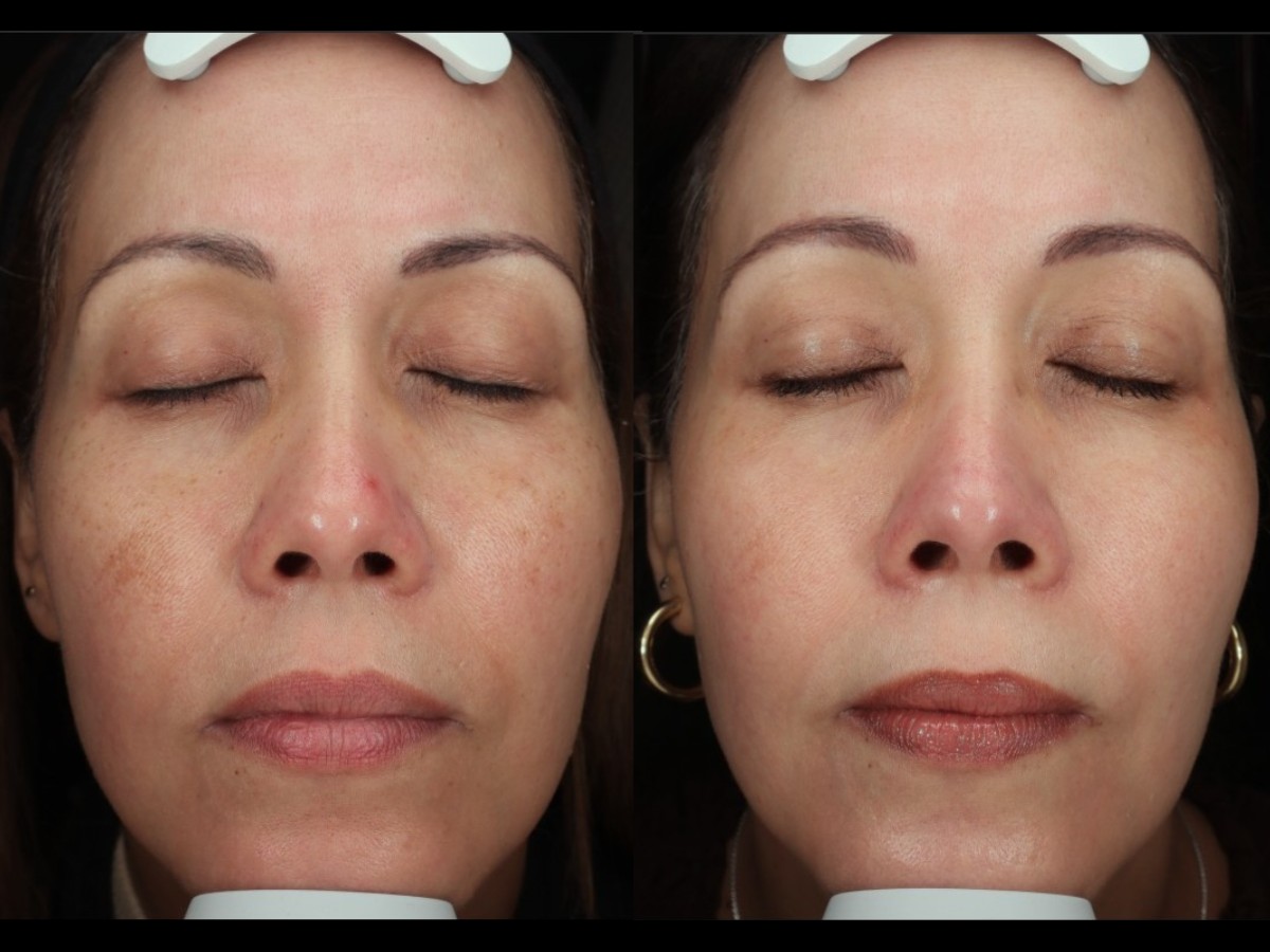 Melasma SylfirmX Photoglow Pavise Protocol