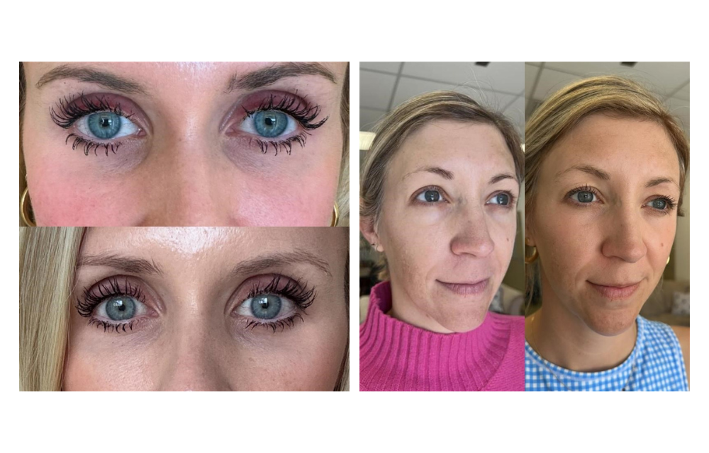 Before and after PDGF under eye treatment