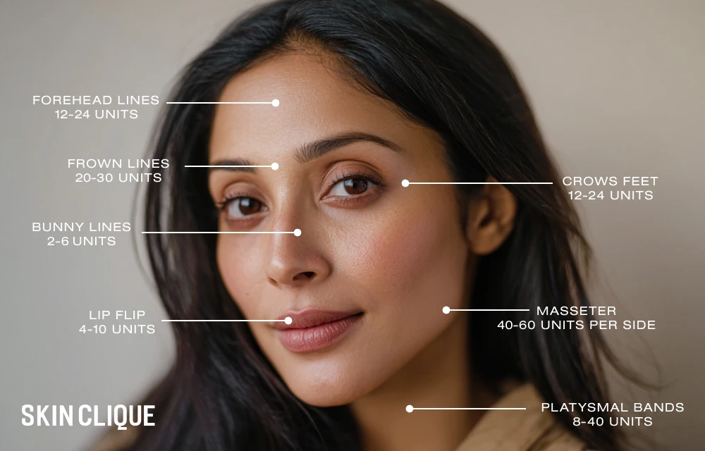 Xeomin treatment areas andunits