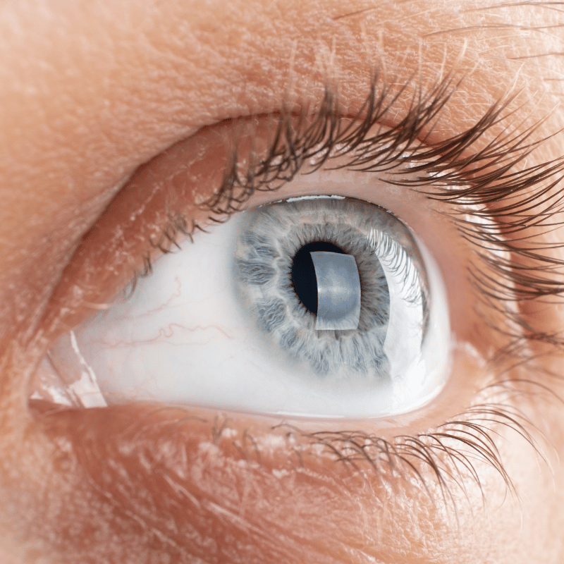 corneal ulcers