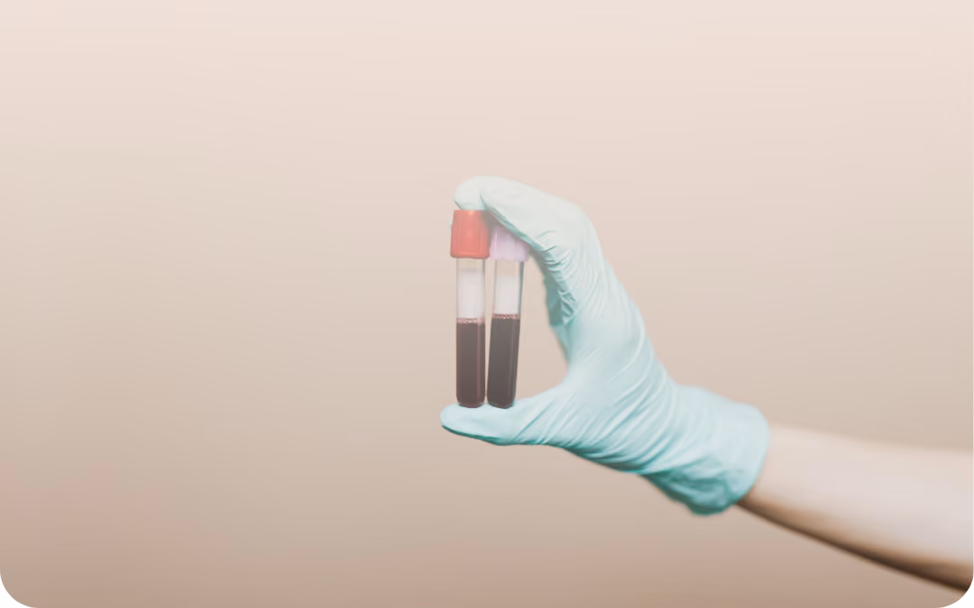 Persona con sensor de monitoreo continuo de glucosa en el brazo usando un teléfono móvil.