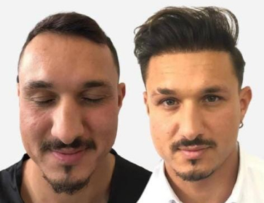 Hair transplant before and after Leeds