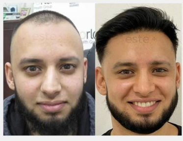 Hair transplant before and after Leeds