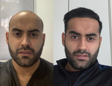 Hair transplant before and after Leeds