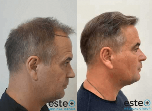 Hair transplant before and after Leeds