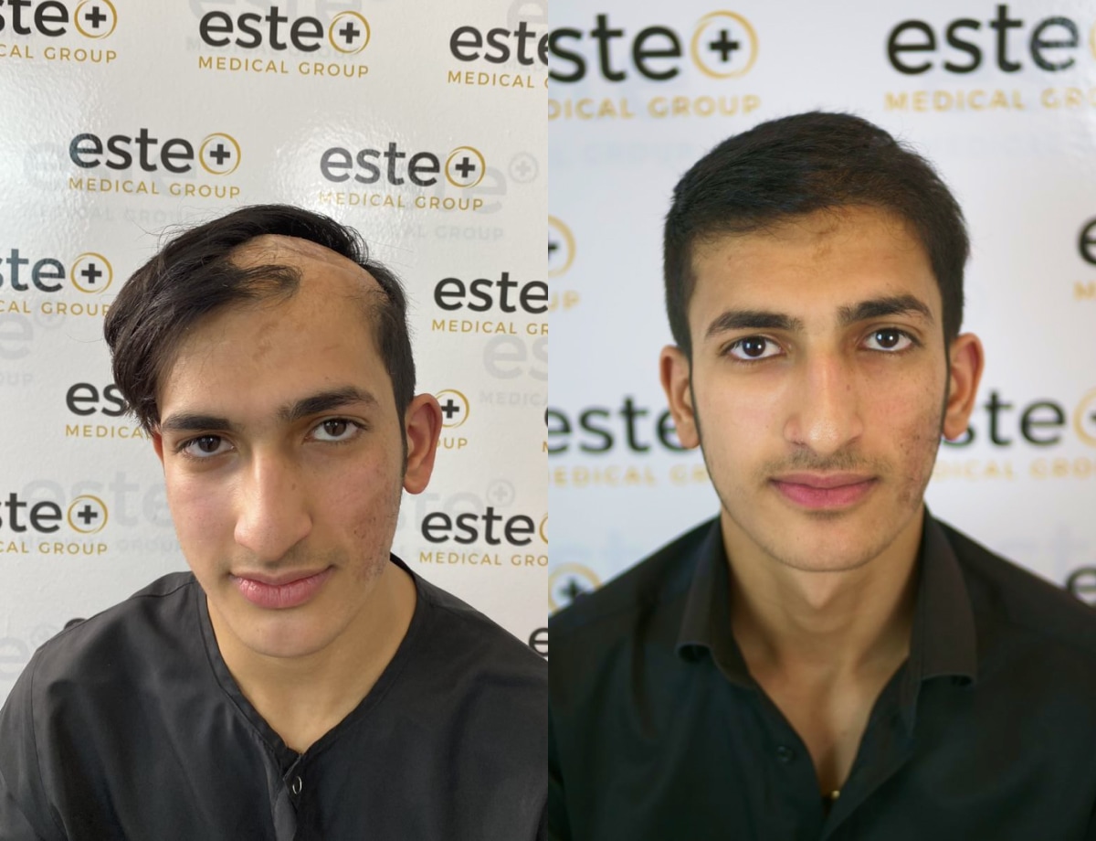 Hair transplant before and after Leeds