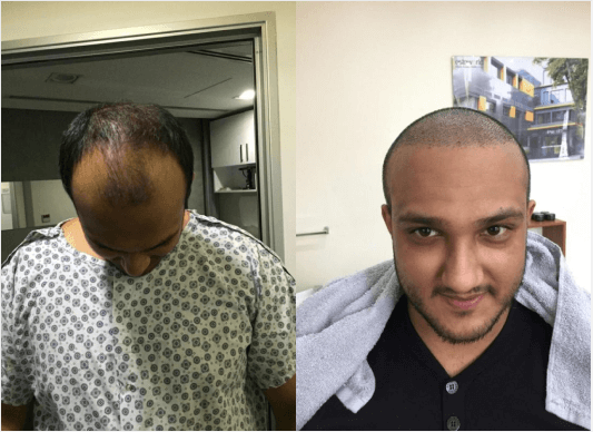 Hair transplant before and after Leeds