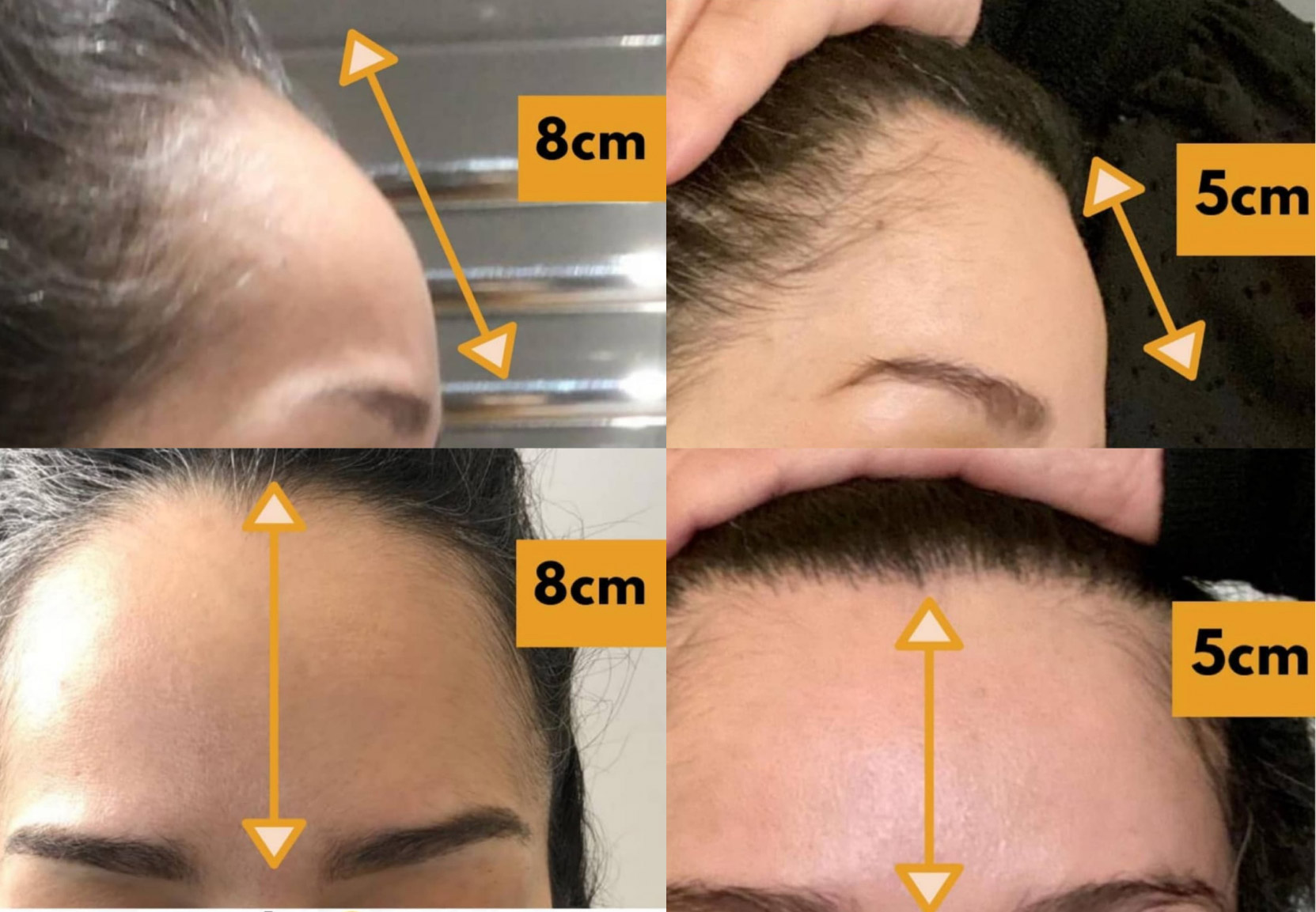 Hair transplant before and after Leeds
