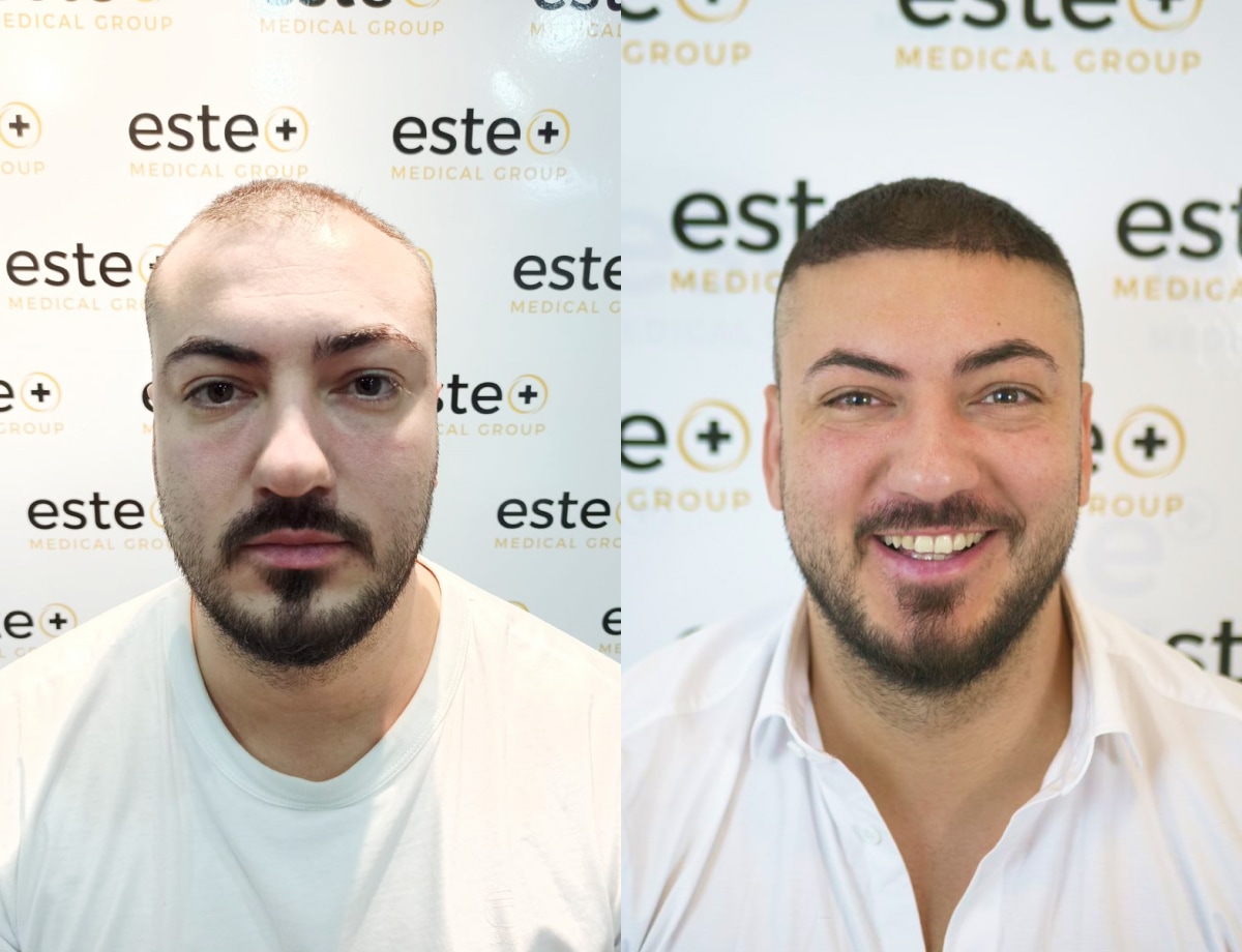 Hair transplant before and after Leeds