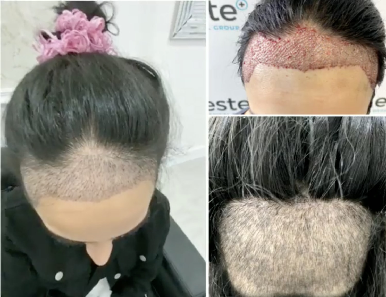 Hair transplant before and after Leeds
