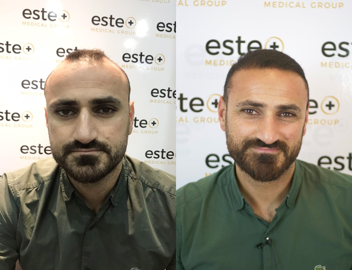 Hair transplant before and after Leeds