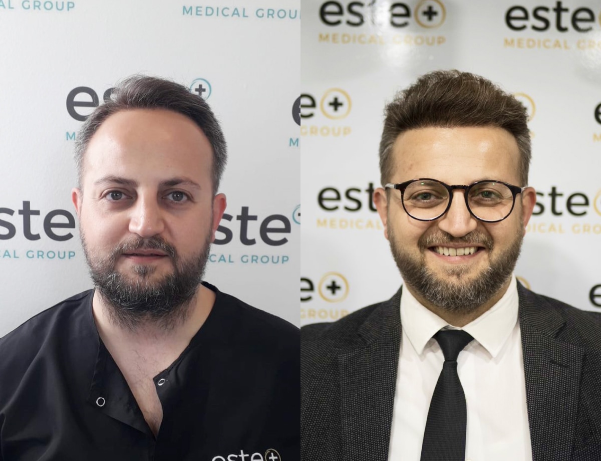 Hair transplant before and after Leeds