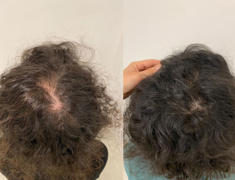 hair loss treatment before after 