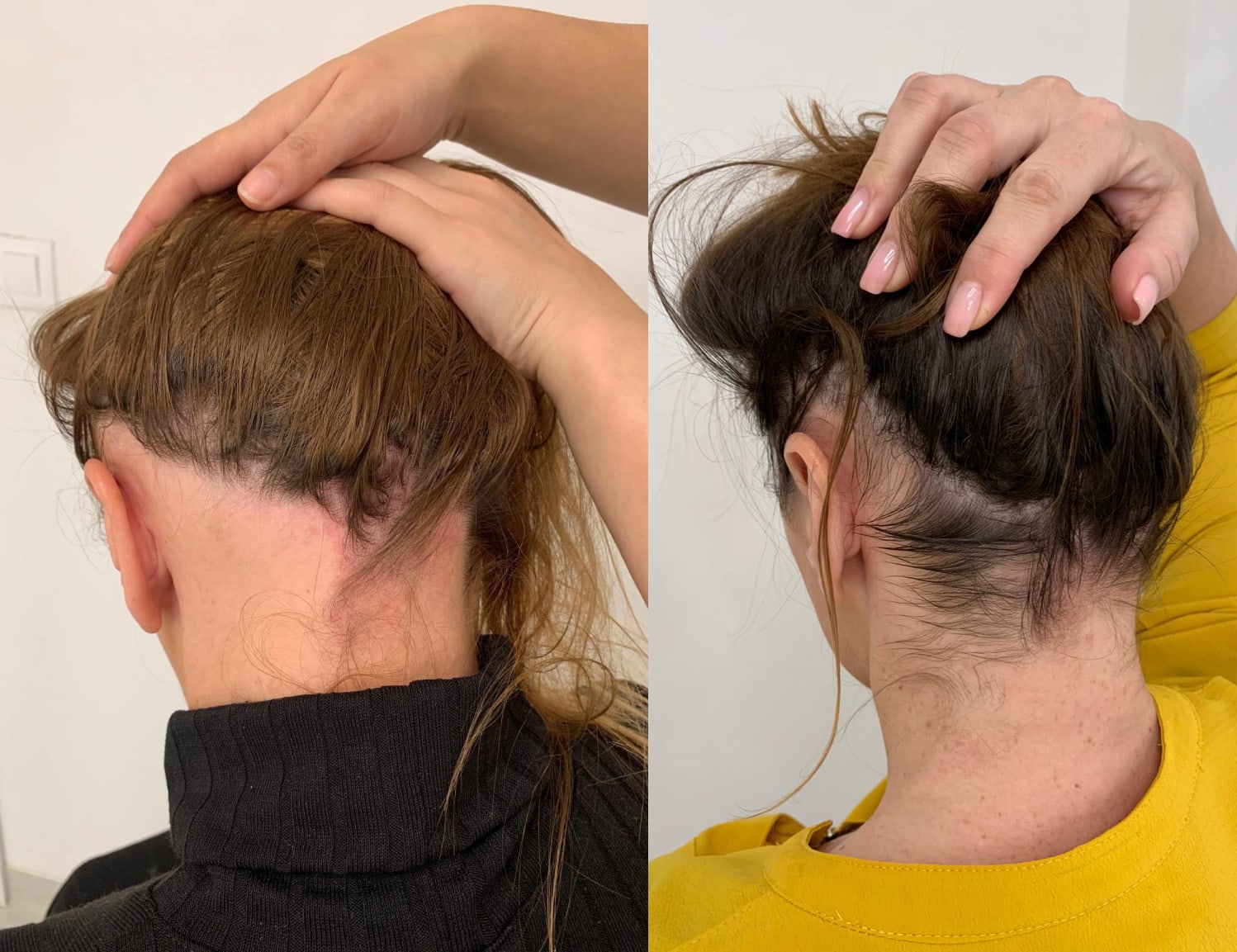 hair loss treatment for women