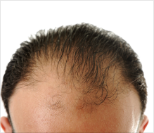 Thinning hair treatments