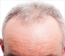 severe hair loss