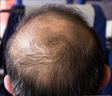 Male hair loss treatment