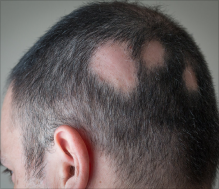 alopecia treatment