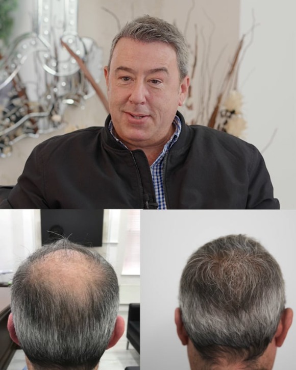 Pen Hair Implant in Turkey