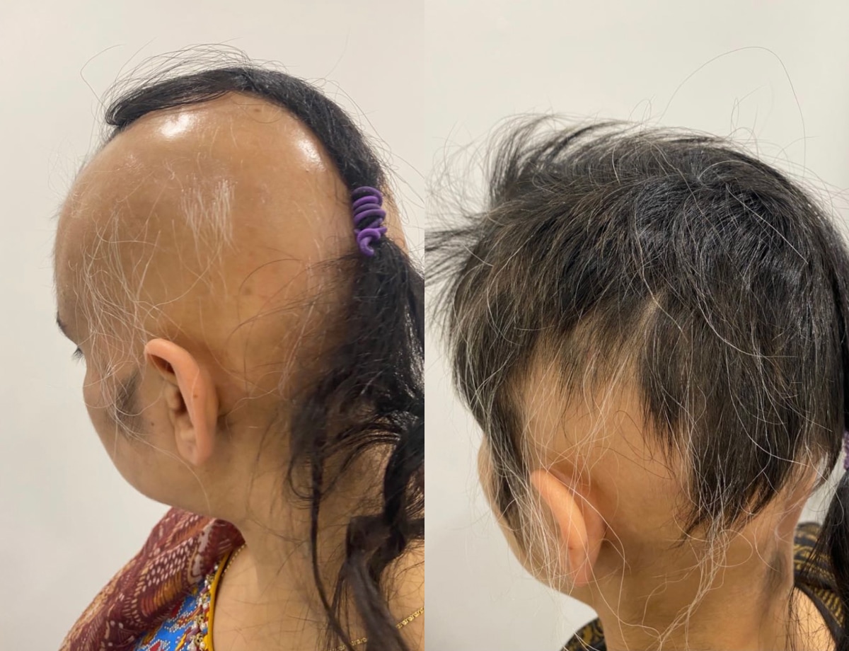 hair loss treatment before after 