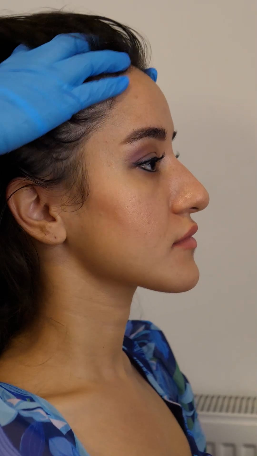 Female Hair Transplant story with Este Medical