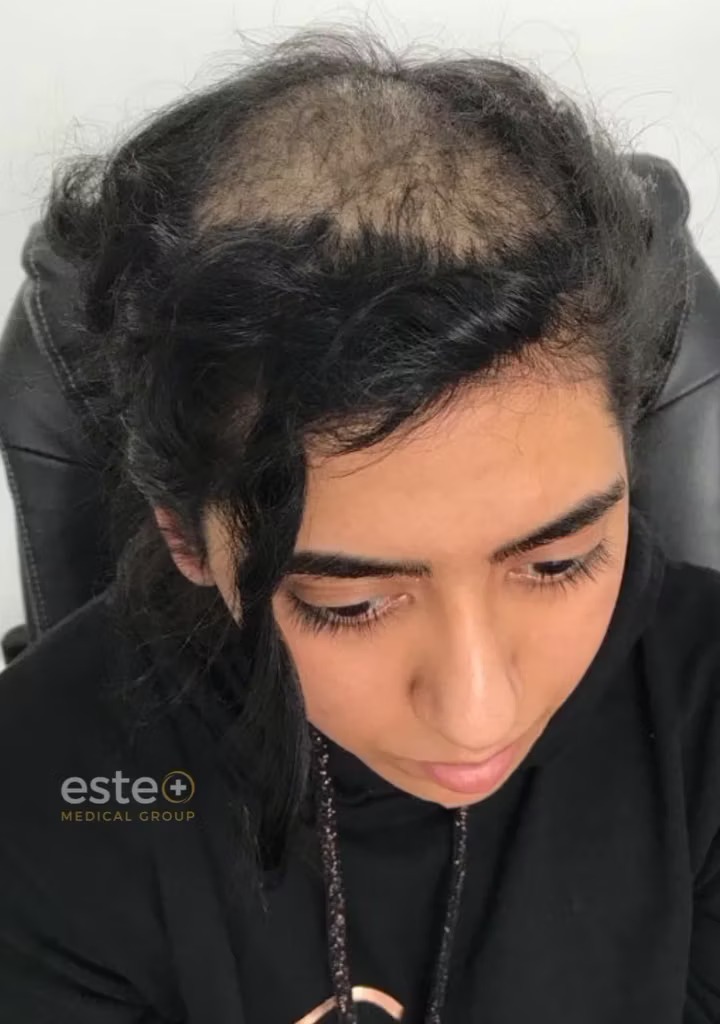 Female Hair Transplant story with Este Medical