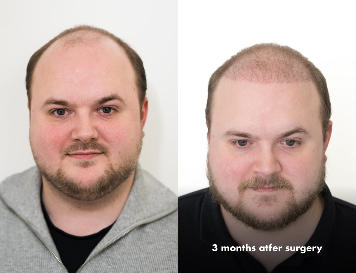 FUE Hair Transplant Results