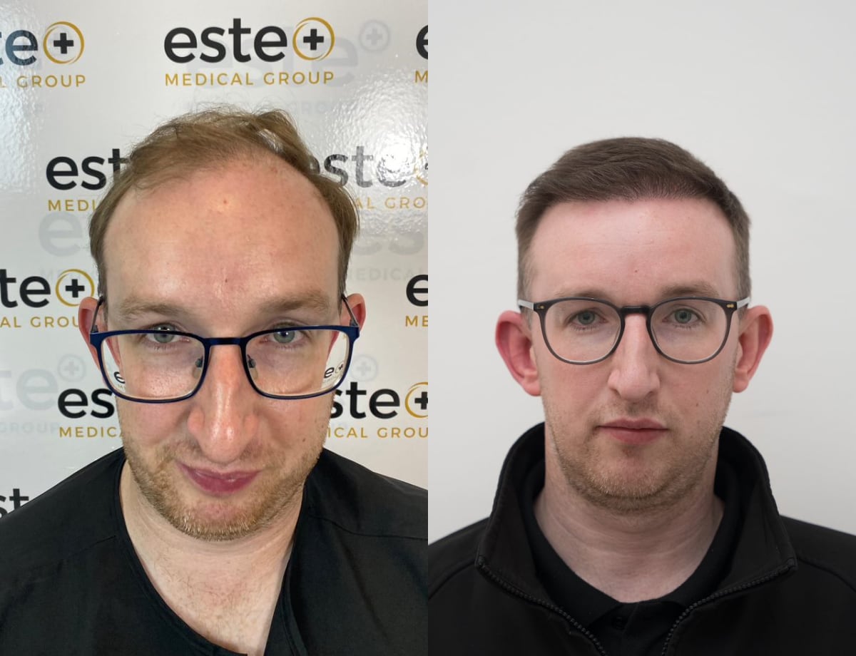 FUE Hair Transplant Results