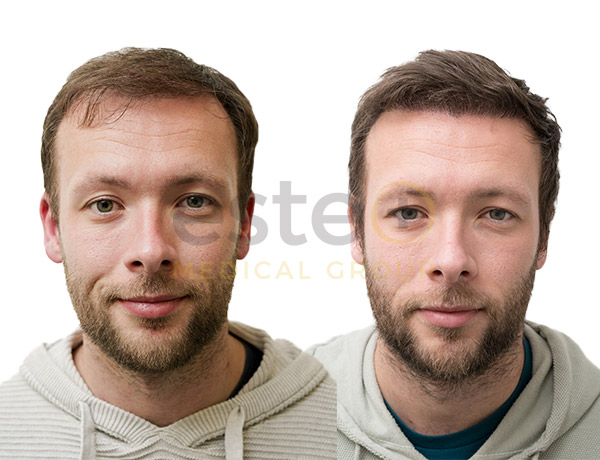 Hair transplant before and after Leeds